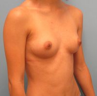 Breast Augmentation - Before
